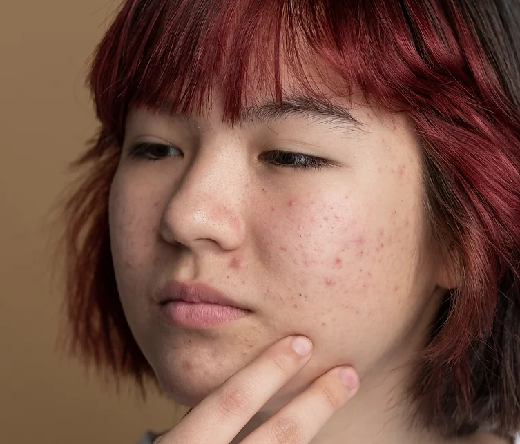 Acne na Adolescência: Causas, Tratamentos e Dicas de Prevenção